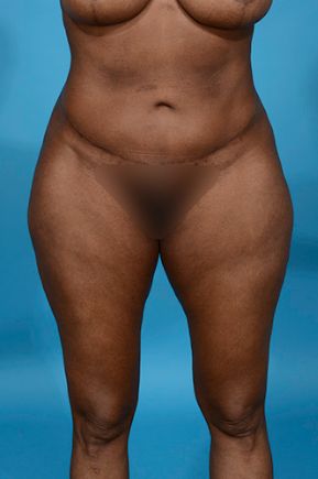 after abdominoplasty front view female patient case 2528