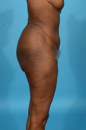 after abdominoplasty right side view female patient case 2528