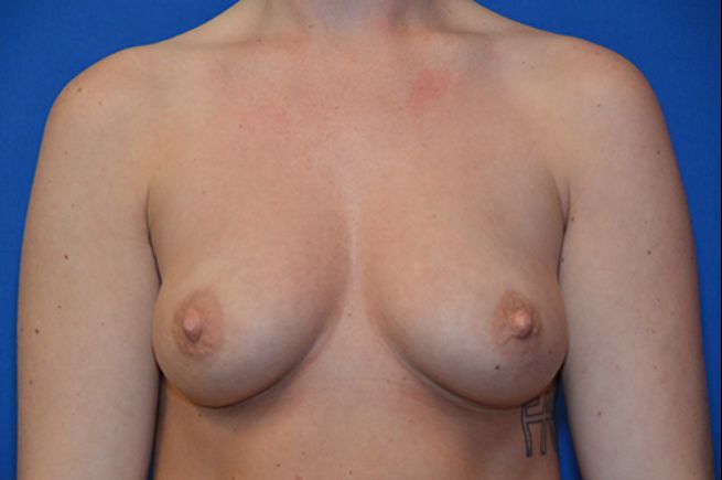 before breast augmentation font view female patient case 2533