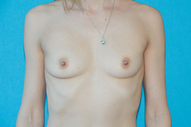 before breast augmentation front view female patient case 2538