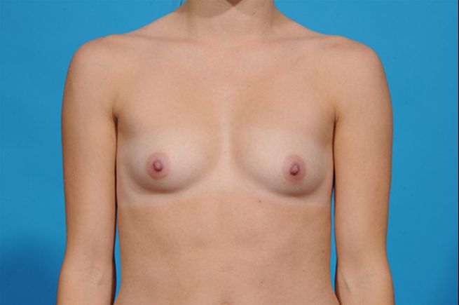 before breast reconstruction front view female patient case 2549