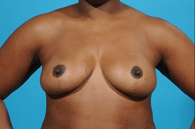 before breast reconstruction front view female patient case 2554