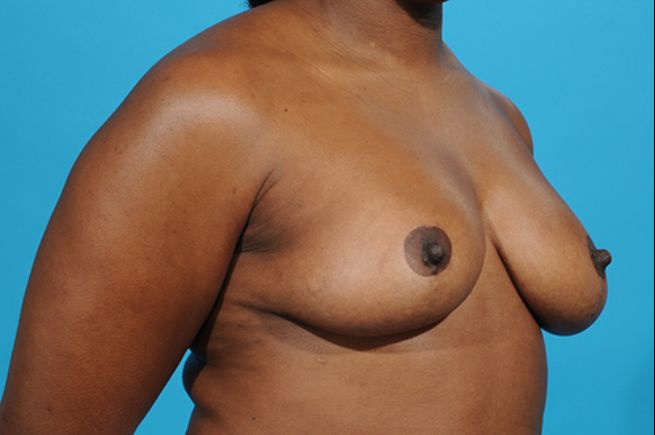 before breast reconstruction right angle view female patient case 2554