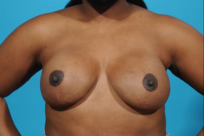 after breast reconstruction front view female patient case 2554