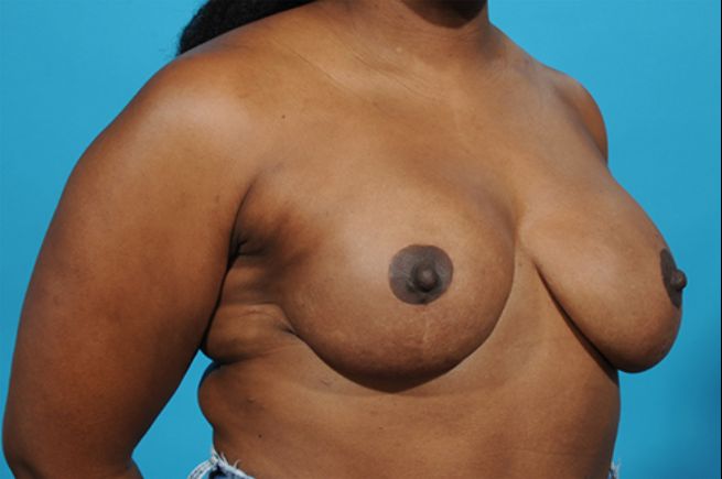 after breast reconstruction right angle view female patient case 2554