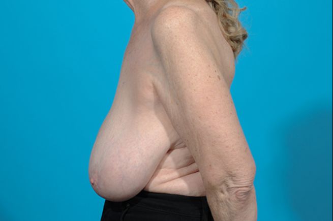 before breast reduction left side view female patient case 2570