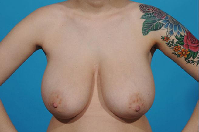 before breast reduction front view female patient case 2575